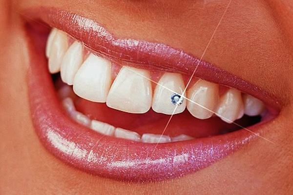 Vì sao nhiều người ưu chuộng đính kim cương lên răng?