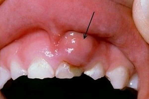Xương hàm răng nổi cục u lồi là gì?