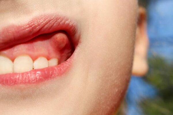 Các biến chứng do xương hàm răng nổi cục u lồi để lại