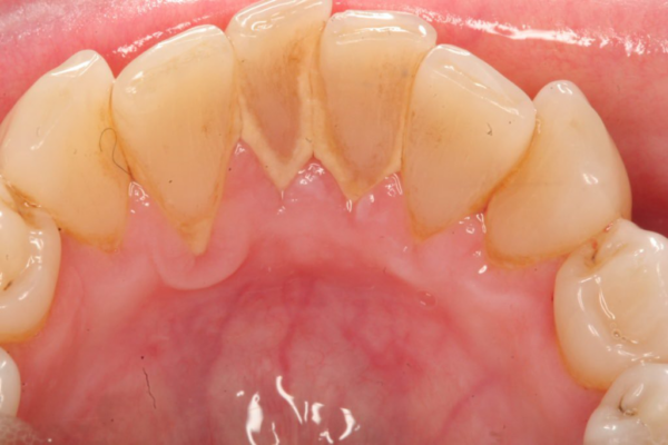 Niềng răng bị tụt lợi thường liên quan đến sự tồn tại của mảng bám cao răng