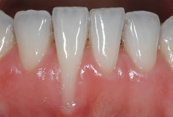 Khi niềng răng, việc nhận diện dấu hiệu của tụt lợi sớm có thể giúp bạn can thiệp kịp thời