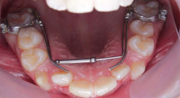 Việc nong hàm đều đặn và đúng cách có thể giúp giải quyết nhiều vấn đề liên quan đến hàm và răng