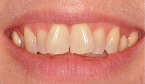Răng cửa là những chiếc răng đặc biệt nằm ở phía trước của miệng chúng ta