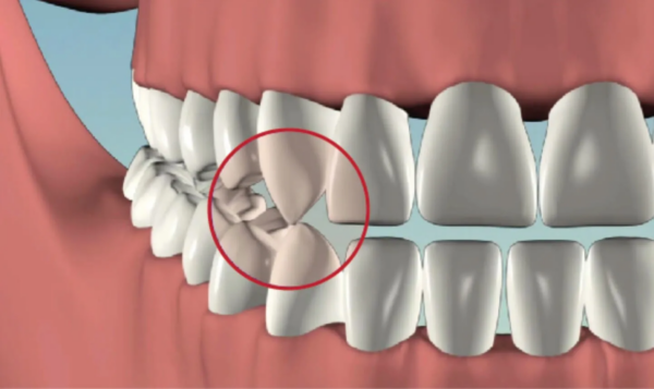 Răng nanh, với hình dạng nhọn và sắc bén, nằm ở phía trước của miệng chúng ta