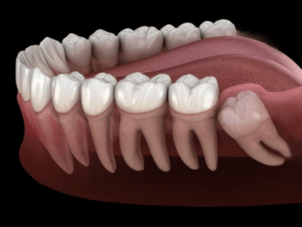 Răng khôn thường nằm ở cuối cùng của khung hàm răng