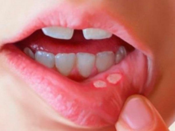 Viêm nhiễm khoang miệng là một tình trạng phổ biến mà nhiều người gặp phải, đặc biệt khi mắc cài bị nuốt phải