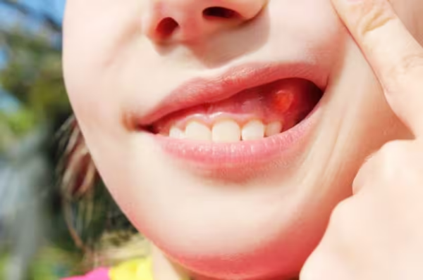 Một biến chứng nghiêm trọng của sâu vỡ là áp xe dương tính, nơi mủ tích tụ trong mô xung quanh răng