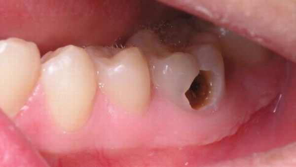 Nhiễm trùng không được kiểm soát, có thể xảy ra lây lan nhiễm trùng từ răng