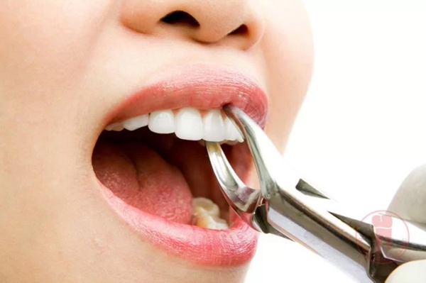 Nhổ răng là biện pháp cuối cùng nhưng cũng là cách hiệu quả để ngăn chặn sự lan rộng của vấn đề