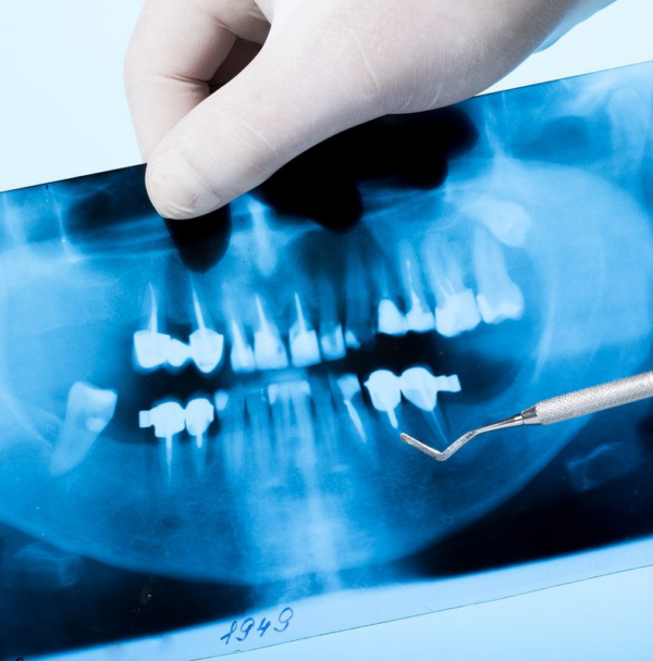 Để có cái nhìn rõ ràng về vị trí và hình dạng của răng khôn, nha sĩ có thể yêu cầu chụp X-quang