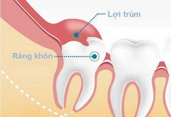 Lợi trùm răng khôn, hay còn gọi là "răng khôn," là bộ răng thứ ba xuất hiện trong hệ thống răng của chúng ta