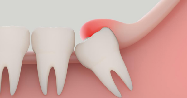 Khi lợi trùm răng khôn bị viêm nhiễm, khu vực xung quanh thường trở nên sưng và có thể đỏ