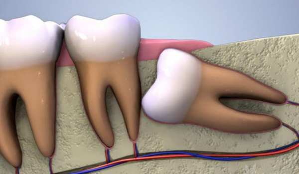 Lợi trùm răng khôn có thể tạo áp lực lên răng láng giềng, gây tổn thương và di chuyển chúng
