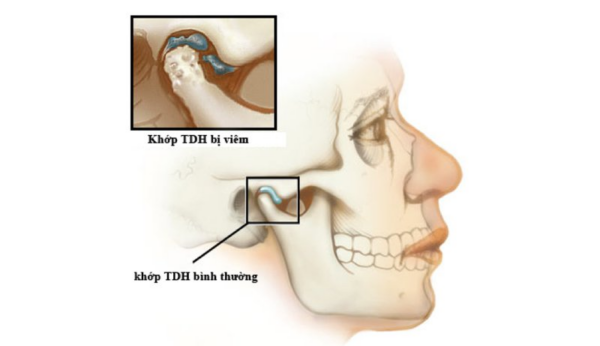 Sự phình to của lợi trùm răng khôn có thể tạo áp lực lên khu vực khớp thái dương hàm