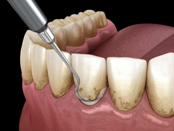 Răng cao nó có thể tạo áp lực không đều khi cắn, dẫn đến việc răng bị mài mòn và đen ở kẽ