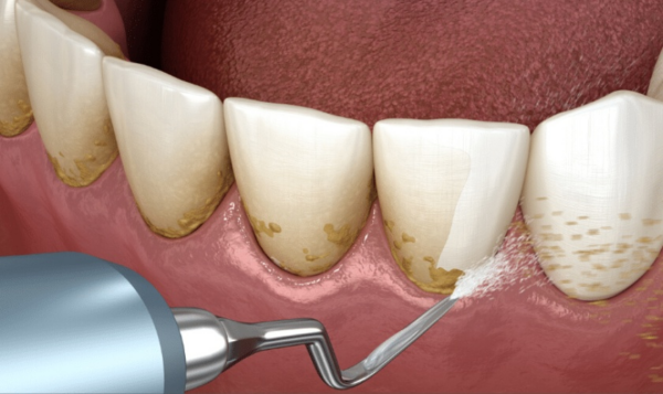 Quy trình cạo vôi răng tại nha khoa giúp loại bỏ các tế bào chết và mảng bám, làm sáng răng và giảm sự đen ở kẽ