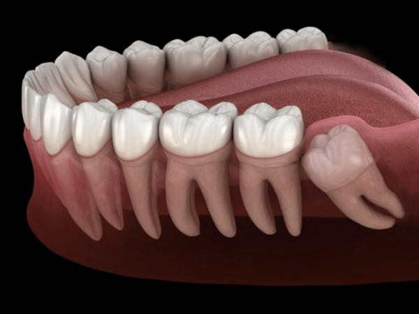 Răng khôn không có đủ không gian để phát triển hoặc mọc theo hướng không đúng, gây ra tình trạng mắc kẹt