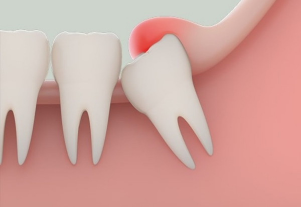 Răng khôn mọc không đúng tạo ra kẽ rãnh nơi mà vi khuẩn dễ xâm nhập, dẫn đến viêm nhiễm và sưng nướu