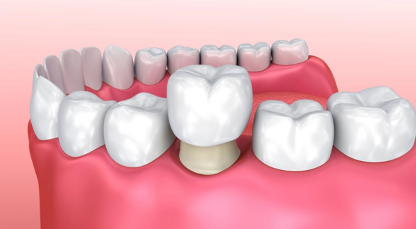 Bọc răng sứ là giải pháp bảo vệ và cải thiện hình dạng của răng