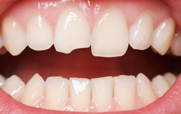 Sức mẻ răng là gì? Nguyên nhân gây mẻ răng