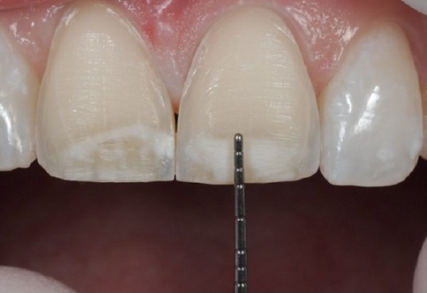 Mài răng không kiểm soát có thể tăng nguy cơ mẻ răng