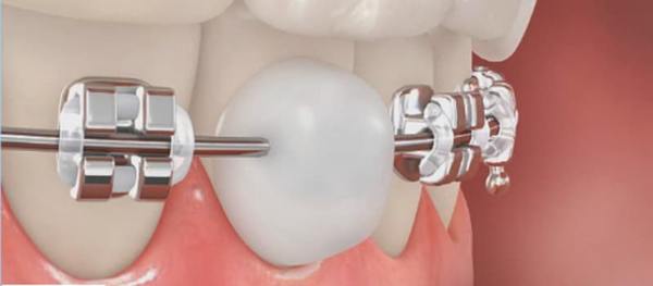 Sáp nha khoa có thể được sử dụng như một biện pháp phòng ngừa để bảo vệ răng