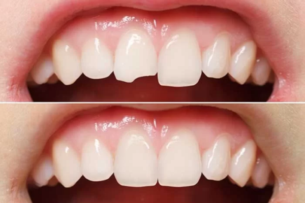 Hàn/trám răng thường được áp dụng cho những vết nứt và mẻ nhỏ