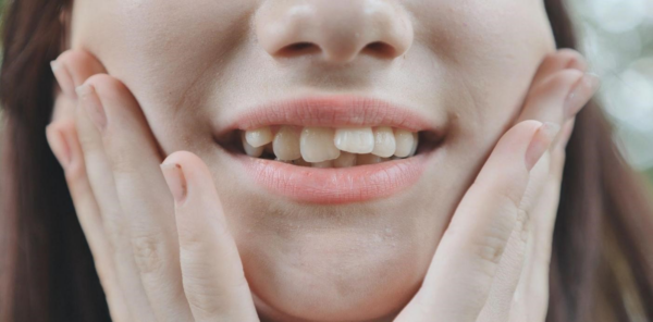Răng không đều là tình trạng như thế nào?
