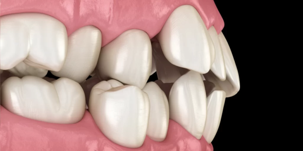 Những răng chồng lên nhau có thể tăng nguy cơ chấn thương