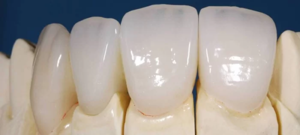 Bọc răng bằng sứ và composite có thể cung cấp kết quả thẩm mỹ tốt, không phù hợp cho các trường hợp lệch lớn