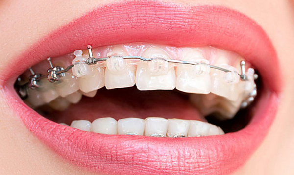 Chỉnh nha có thể giải quyết nhiều vấn đề hàm răng và hàm mặt
