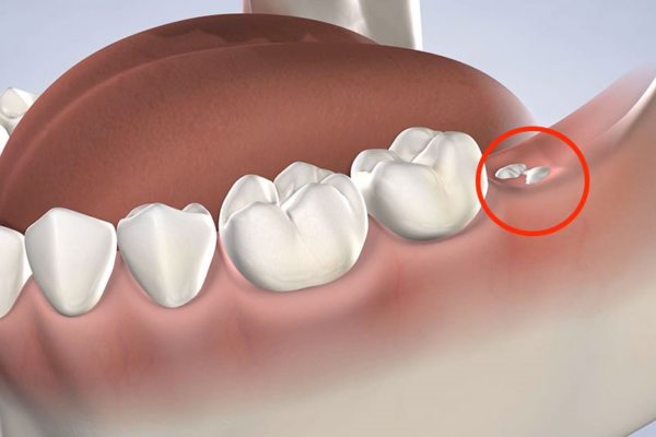 Răng khôn, còn được gọi là răng số 8, là những chiếc răng cuối cùng mọc ở cả hai bên của hàm trên và dưới