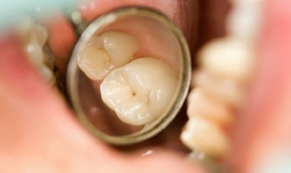 Răng có thể bắt đầu xuất hiện mảng màu trắng hoặc đen