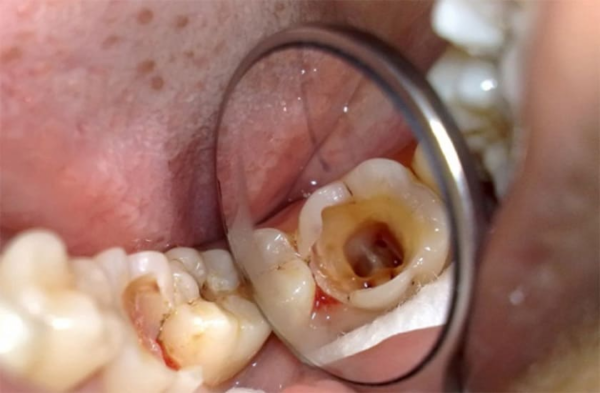 Mảng màu trắng hoặc đen lan rộng rất nhanh, và có thể có sự tàn phá nghiêm trọng đến men răng và cấu trúc răng chính