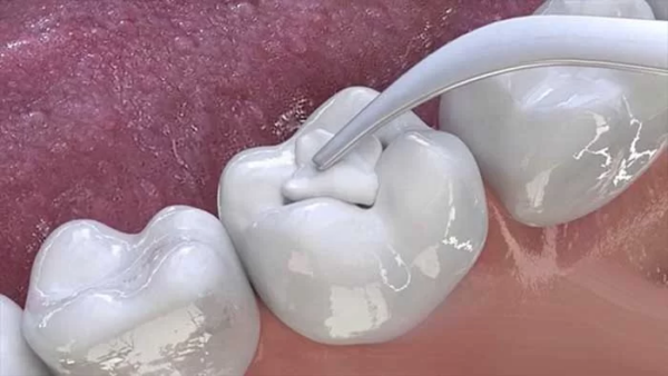 Trám răng là một phương pháp hiệu quả để khắc phục sâu răng hàm