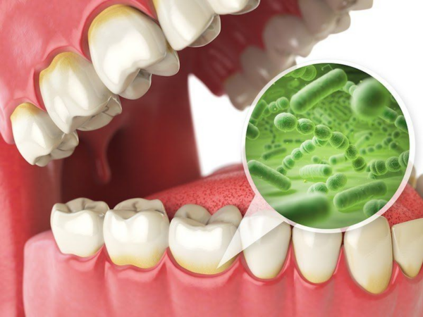 Vi khuẩn Streptococcus mutans (S. mutans) là một trong những đối tượng chính được xác định liên quan mật thiết đến sự xuất hiện của sâu răng