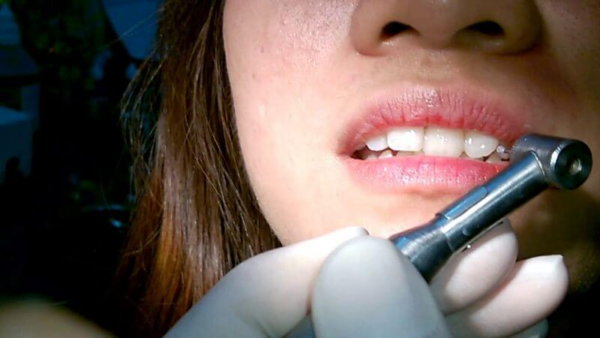 Phương pháp gắn đá này đòi hỏi việc khoan những lỗ nhỏ vào răng để đặt đá quý
