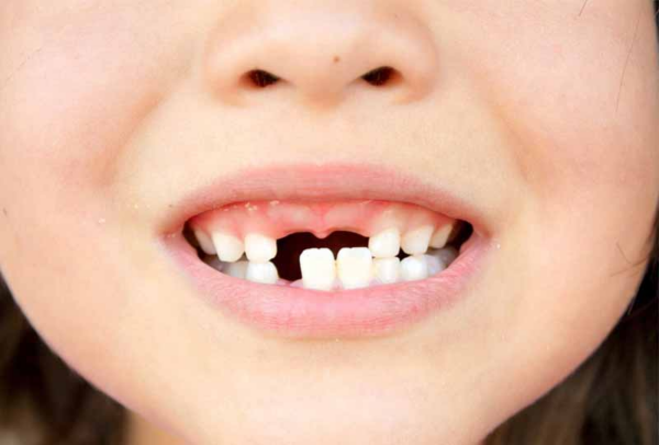 Răng sún không chỉ đơn thuần là một vấn đề về thẩm mỹ, mà còn là một hiện tượng ảnh hưởng đến sức khỏe răng miệng của trẻ
