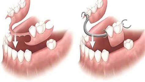 Hàm khung tháo lắp có chức năng thay thế hàm răng một cách hoàn hảo