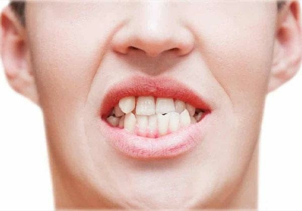 Răng lệch lạc là gì?