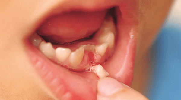 Mất răng sữa sớm trước khi đổi răng là nguyên nhân phổ biến gây ra tình trạng răng vĩnh viễn mọc lệch lạc