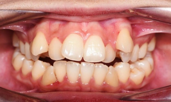 Răng lệch lạc gây ra các hậu quả nghiêm trọng về sức khỏe và tinh thần