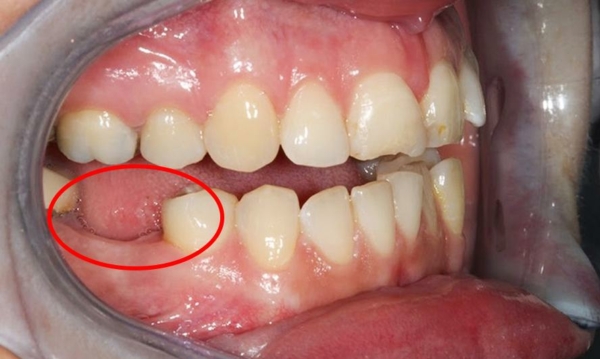 Quá trình nhổ răng tiềm ẩn một số nguy cơ, ảnh hưởng nhất định