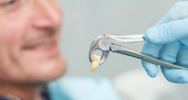 Chi phí nhổ răng hàm dưới là bao nhiêu?