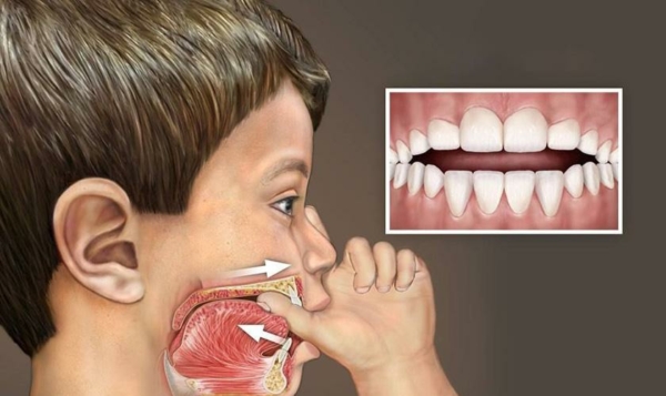 Trẻ có thói quen mút tay thường xuyên và kéo dài sẽ khiến răng dễ bị lệch lạc