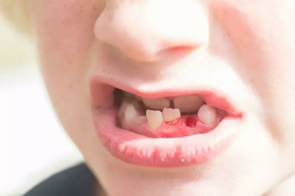 Các dấu hiệu nhận biết răng trẻ mọc lệch