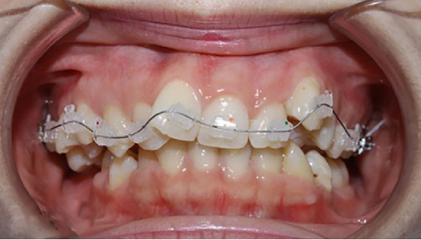 Band niềng răng được lắp đặt trong những trường hợp răng hàm mất cân đối cần phải niềng răng để điều chỉnh lại