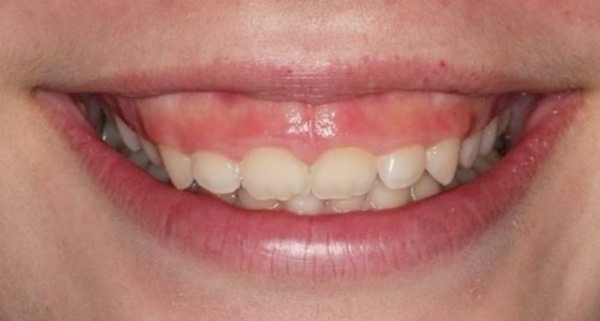 Răng ngắn là tình trạng răng có chiều dài nhỏ hơn so với tiêu chuẩn bình thường