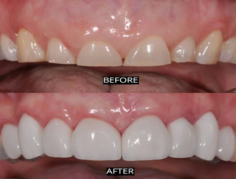 Tình trạng răng bị ngắn sẽ gây ra nhiều hậu quả đáng tiếc, ảnh hưởng xấu tới thẩm mỹ và sức khỏe răng miệng