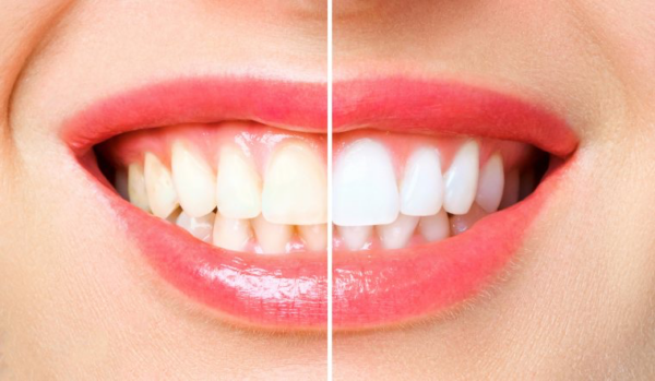 Cao răng có thể làm cho hàm răng bị ố vàng